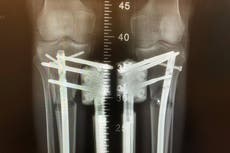 Inside the world of limb-lengthening surgery