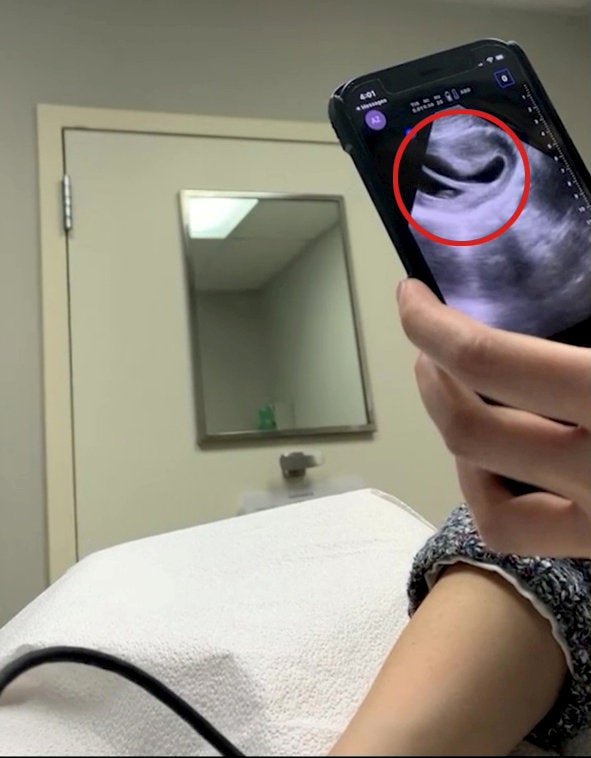 Karen having the scan where she found out she had a heart-shaped uterus (red circle)