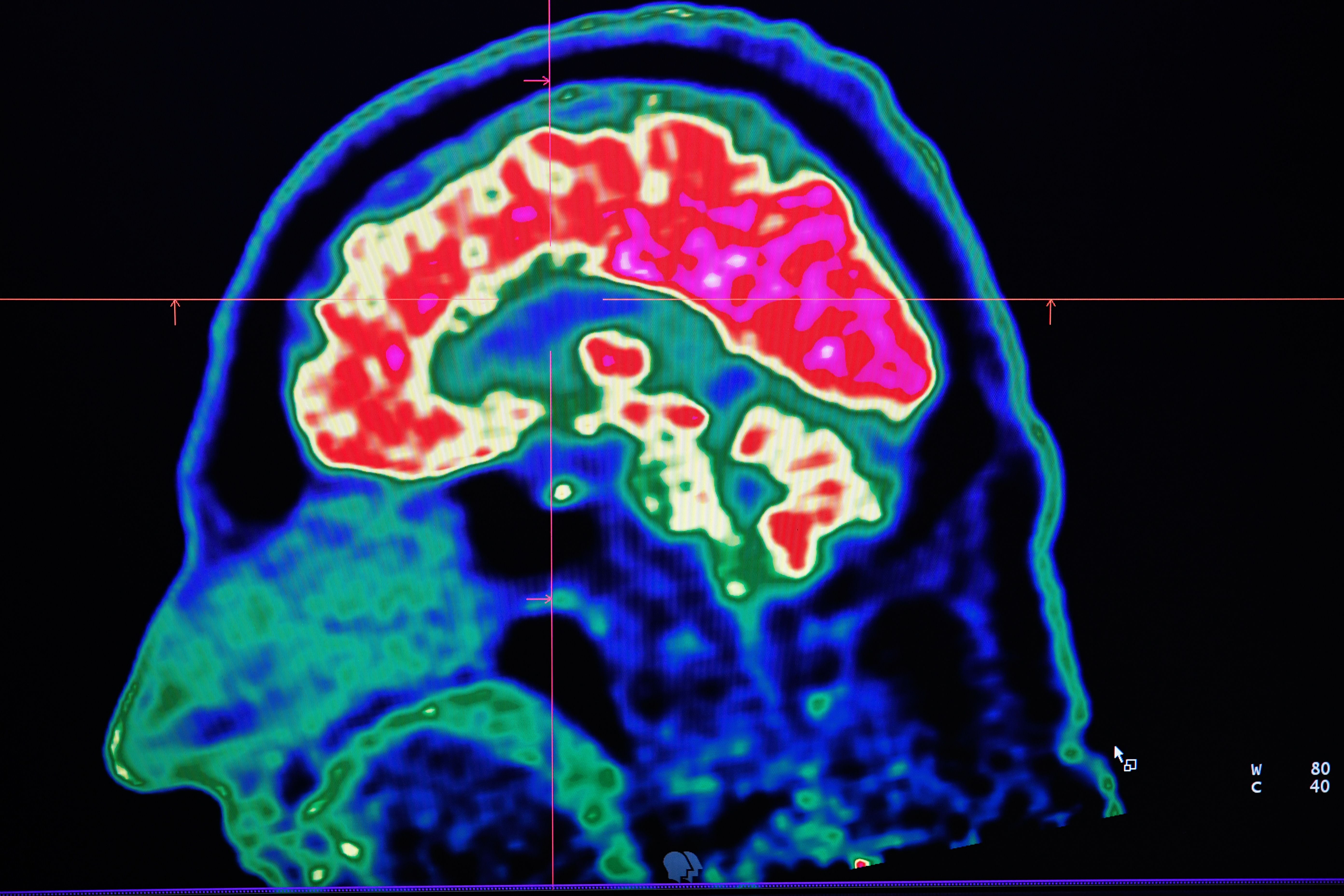 A picture of a human brain taken by a positron emission tomography scanner, also called PET scan, is seen on a screen on January 9, 2019, at the Regional and University Hospital Center of Brest (CRHU - Centre Hospitalier Régional et Universitaire de Brest), western France