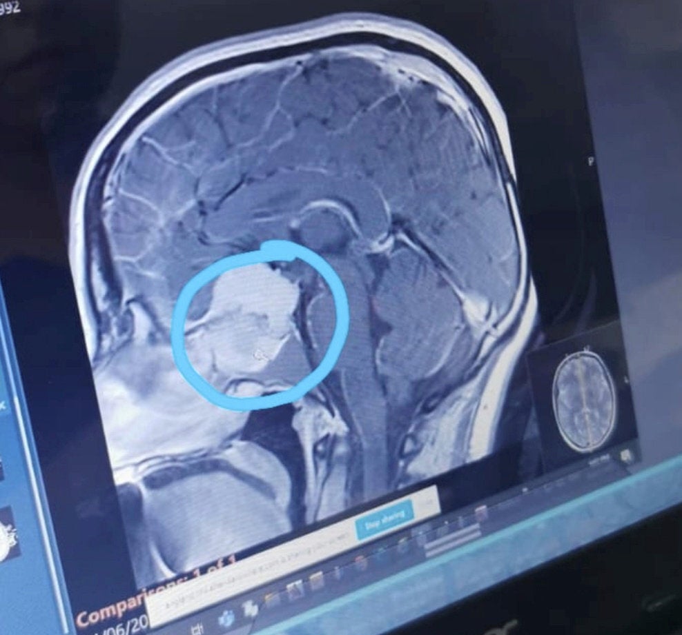 A scan of the tumour (circled) in Katie Dunn's brain, 20 October 2021