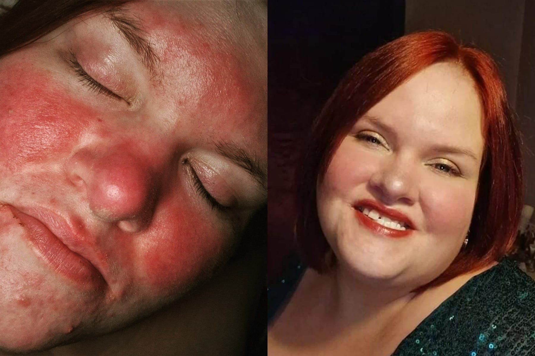 Natalie feels much happier with her skin now (Collect/PA Real Life)