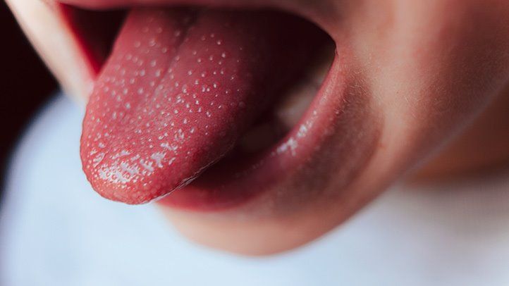 A common early symptom of the disease is a red and swollen tongue with red spots, referred to as ‘strawberry tongue’