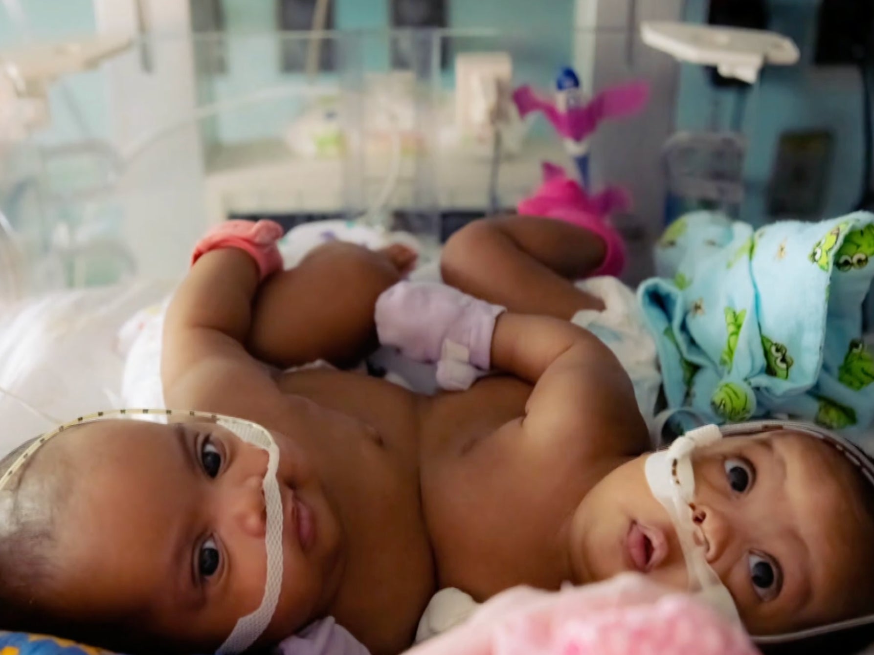 Two conjoined twins were separated during a surgery in Texas
