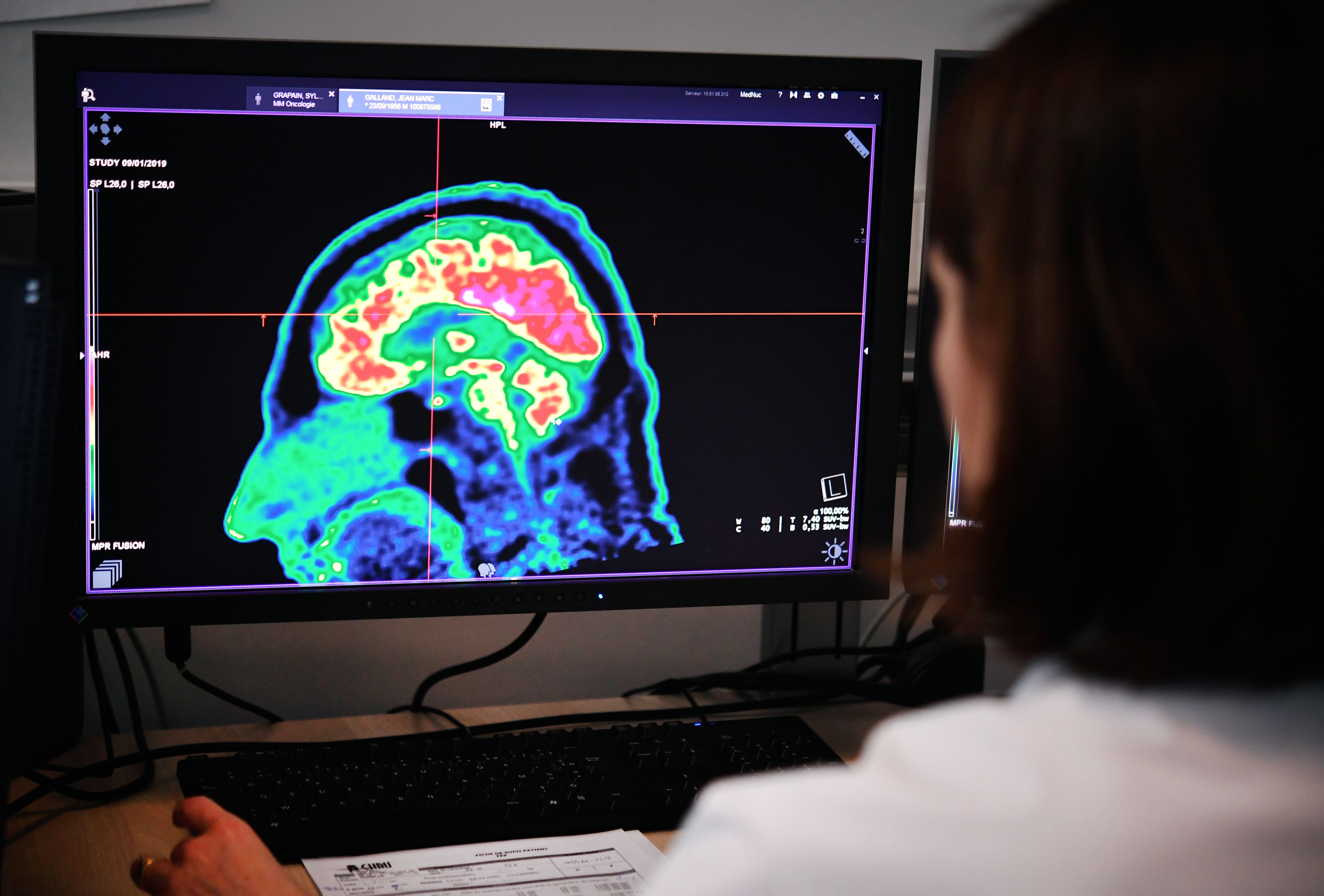 A picture of a human brain taken by a positron emission tomography scanner