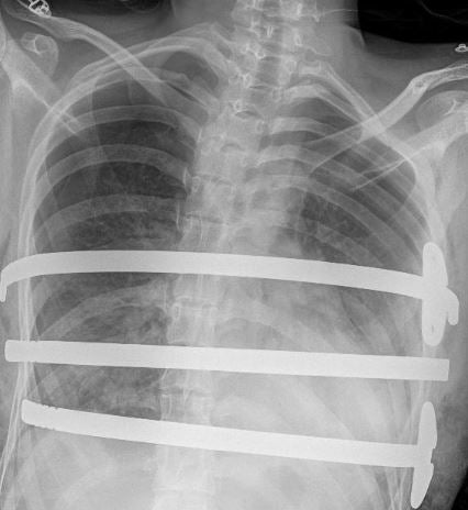 An X-ray of Ellie Musgrove’s chest after she underwent surgery for pectus