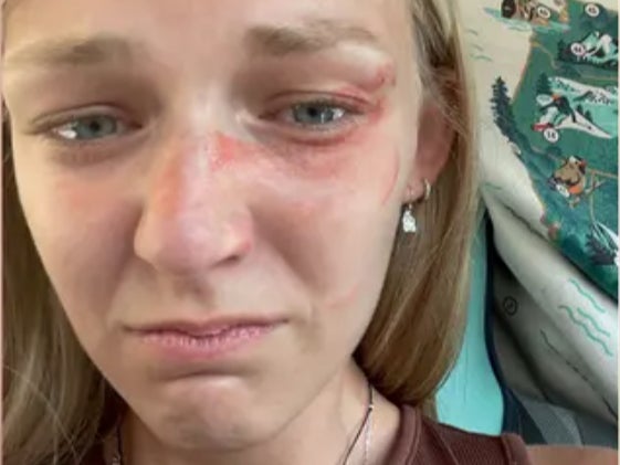 A photo of Gabby Petito showing blood and bruises on her face just before her and her ex-fiance Brian Laundrie were stopped by Moab police officers investigating a domestic abuse call