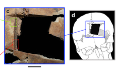 Earliest evidence of ‘uncommon’ type of brain surgery found in Israel