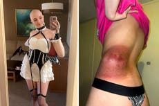 ‘Men love my bald head’: OnlyFans model diagnosed with rare cancer still makes £66,000 a year
