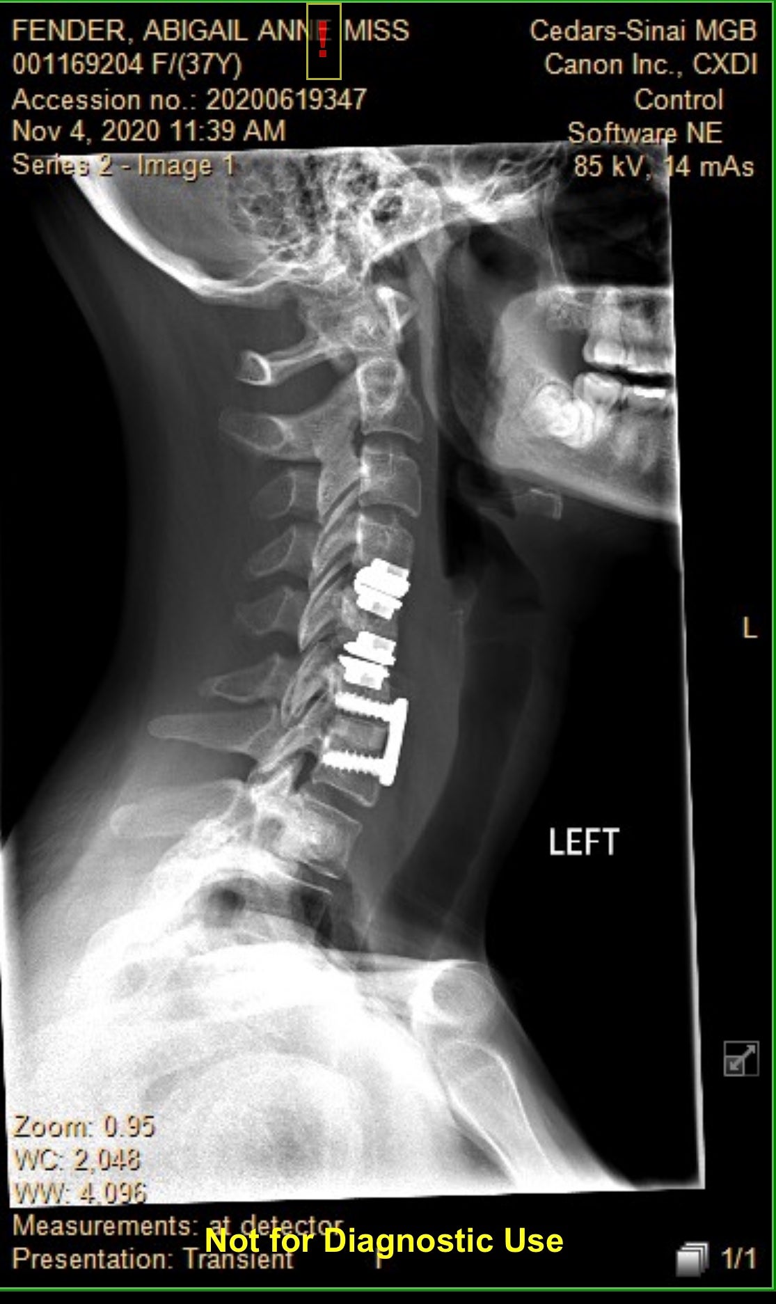 Pictured: A scan of Abby’s neck with new fused plates and screws with disc replacements.