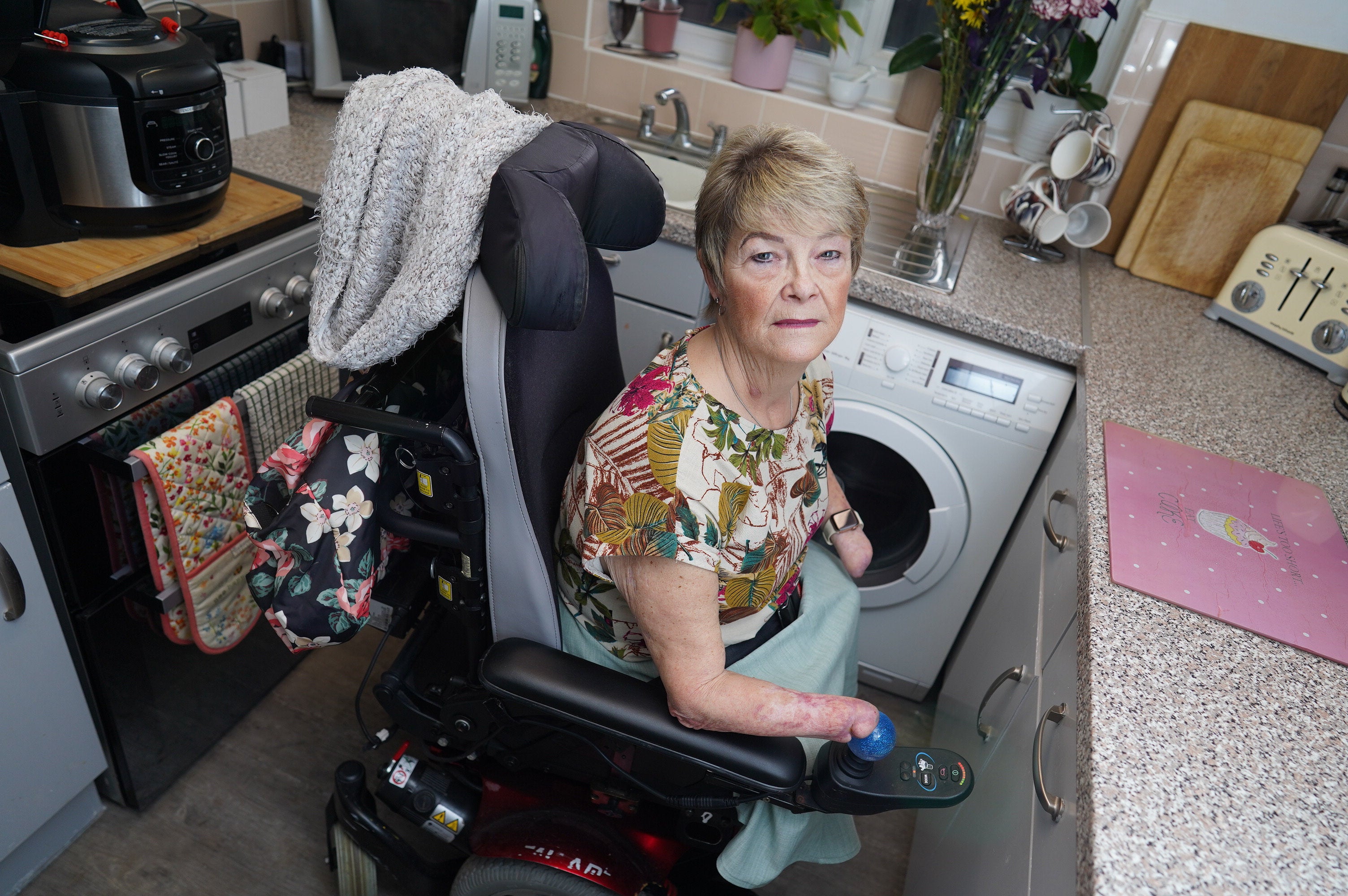 Kim Smith, 61 of Milton Keynes, has spoken about her sepsis journey and her plans to get a hand transplant