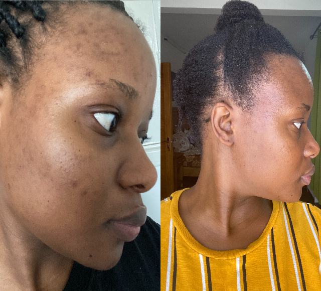 Sh’anesus skin after 6 month’s use, Dermatica.co.uk