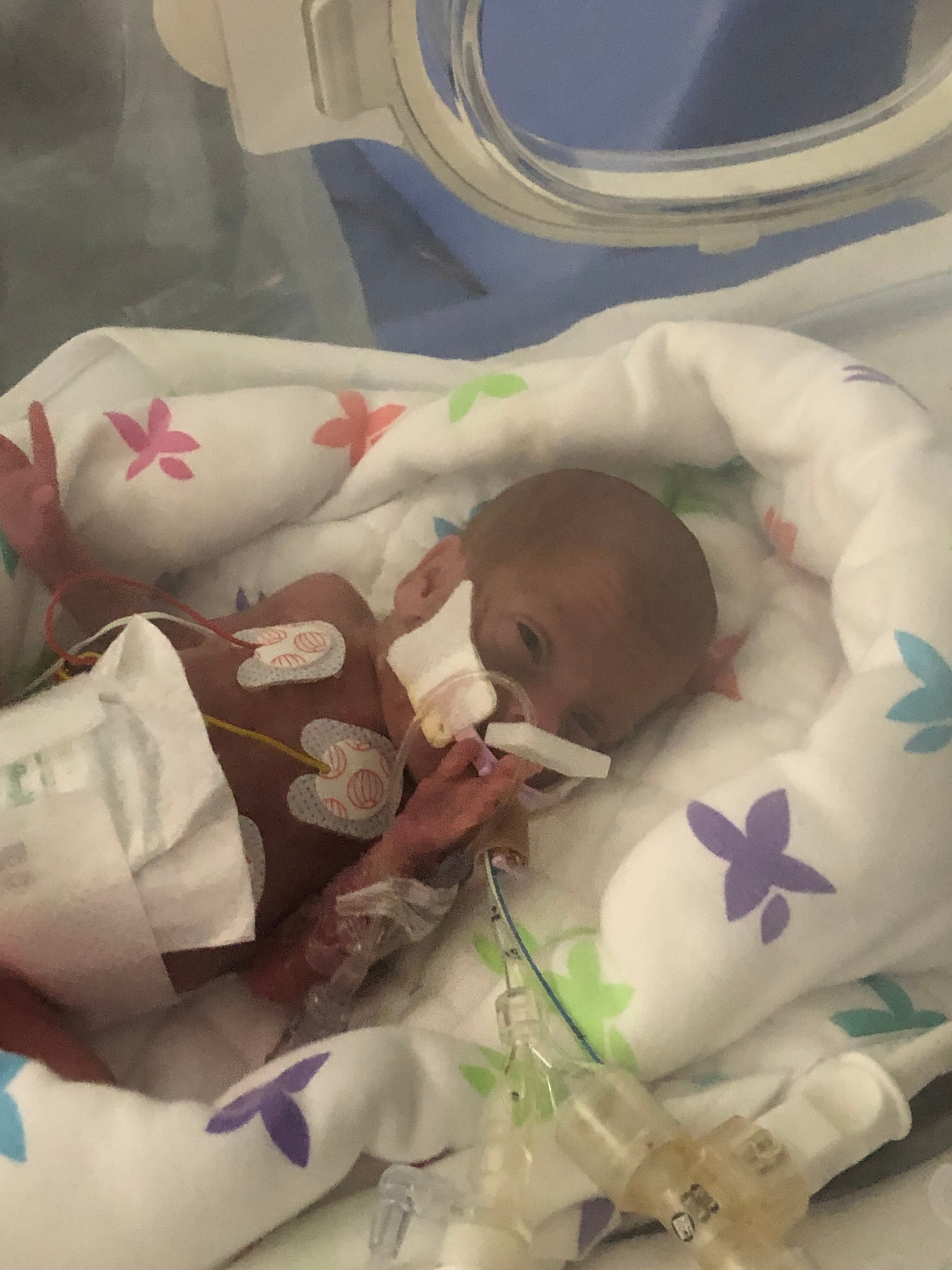 One of the triplets in the NICU after their premature birth