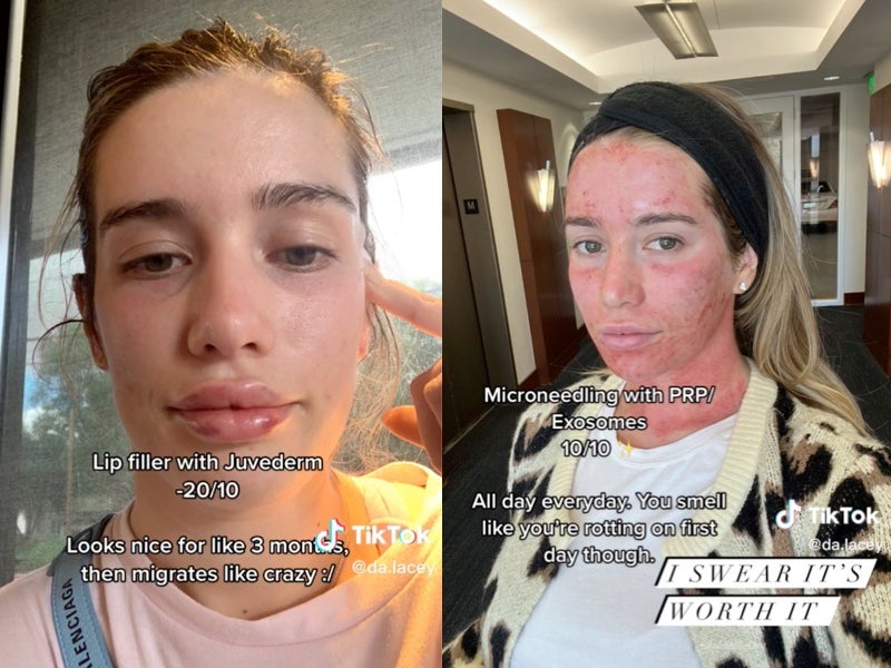 From filler to CoolSculpting: Woman ranks 10 best cosmetics procedures and reveals which to avoid