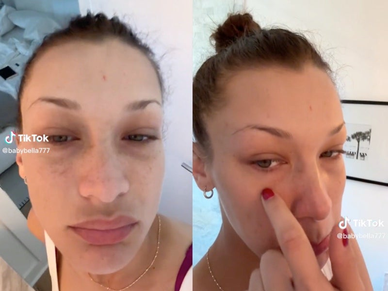 Bella Hadid shows off inflammation due to Lyme disease flare up