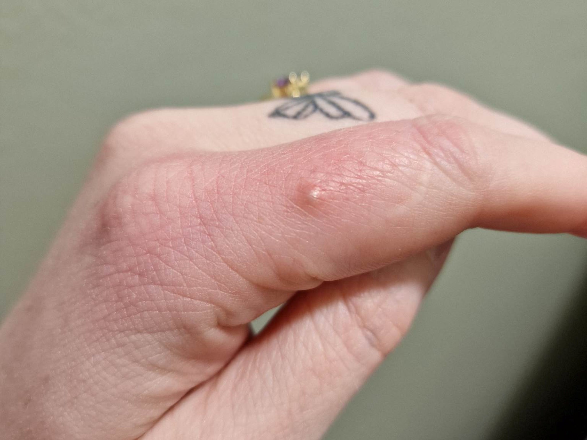 The bite mark started as what appeared to be a small pimple