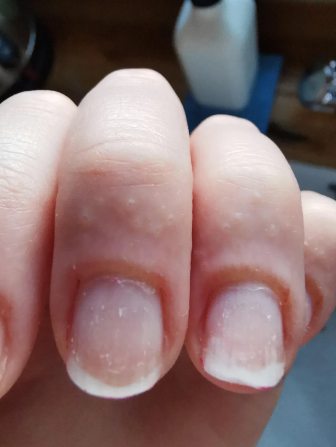 A person shows the allergic reaction on their fingers after using an at-home gel polish manicure kit