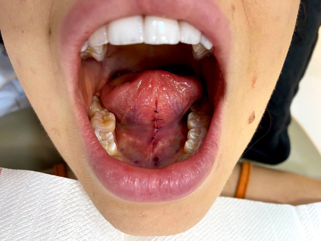 Rochelle Garett’s mouth is seen after her tongue procedure