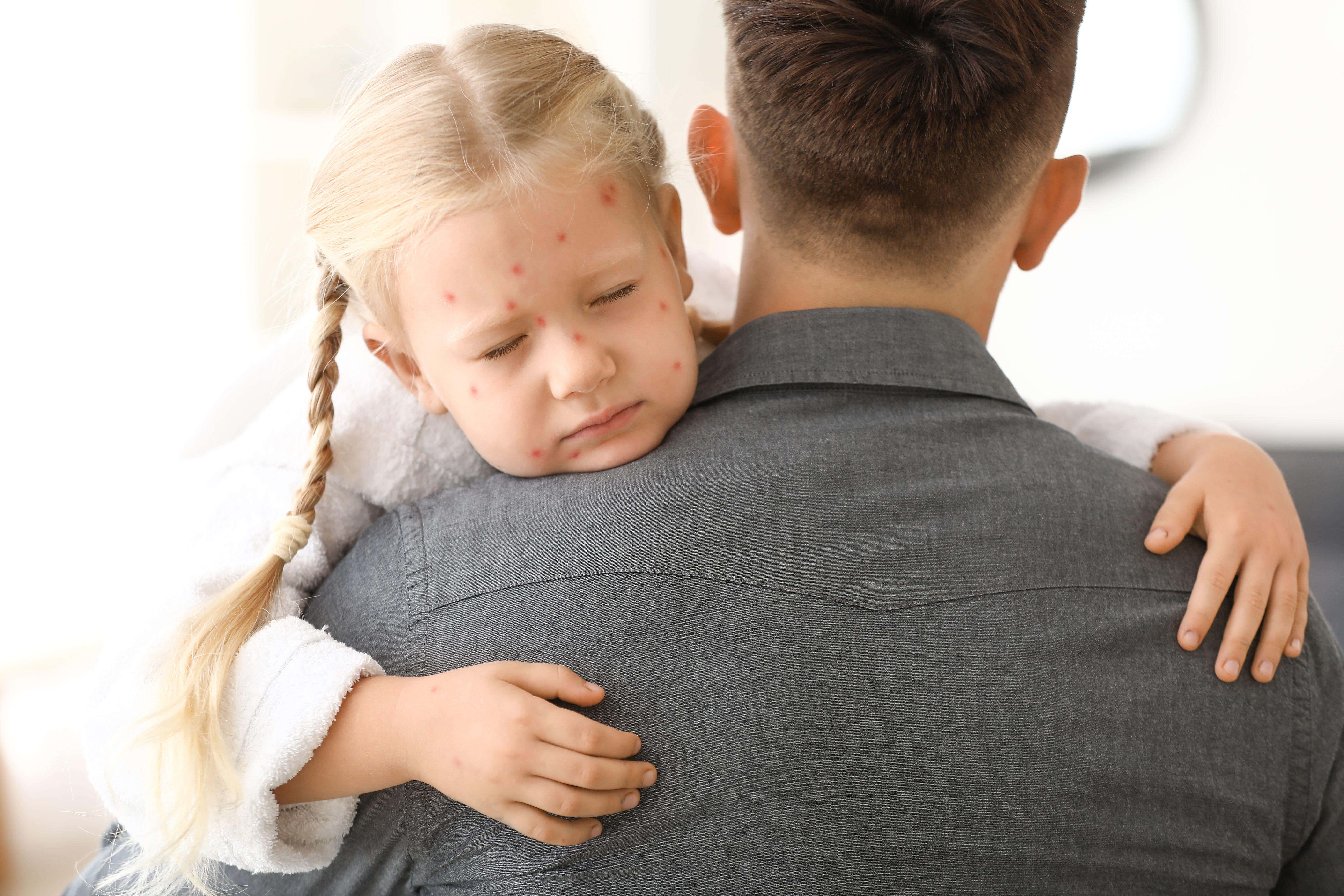 Can I go to work if my child has chickenpox? (Alamy/PA)