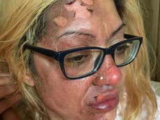 Mother’s warning after viral TikTok hack left skin peeling from her face