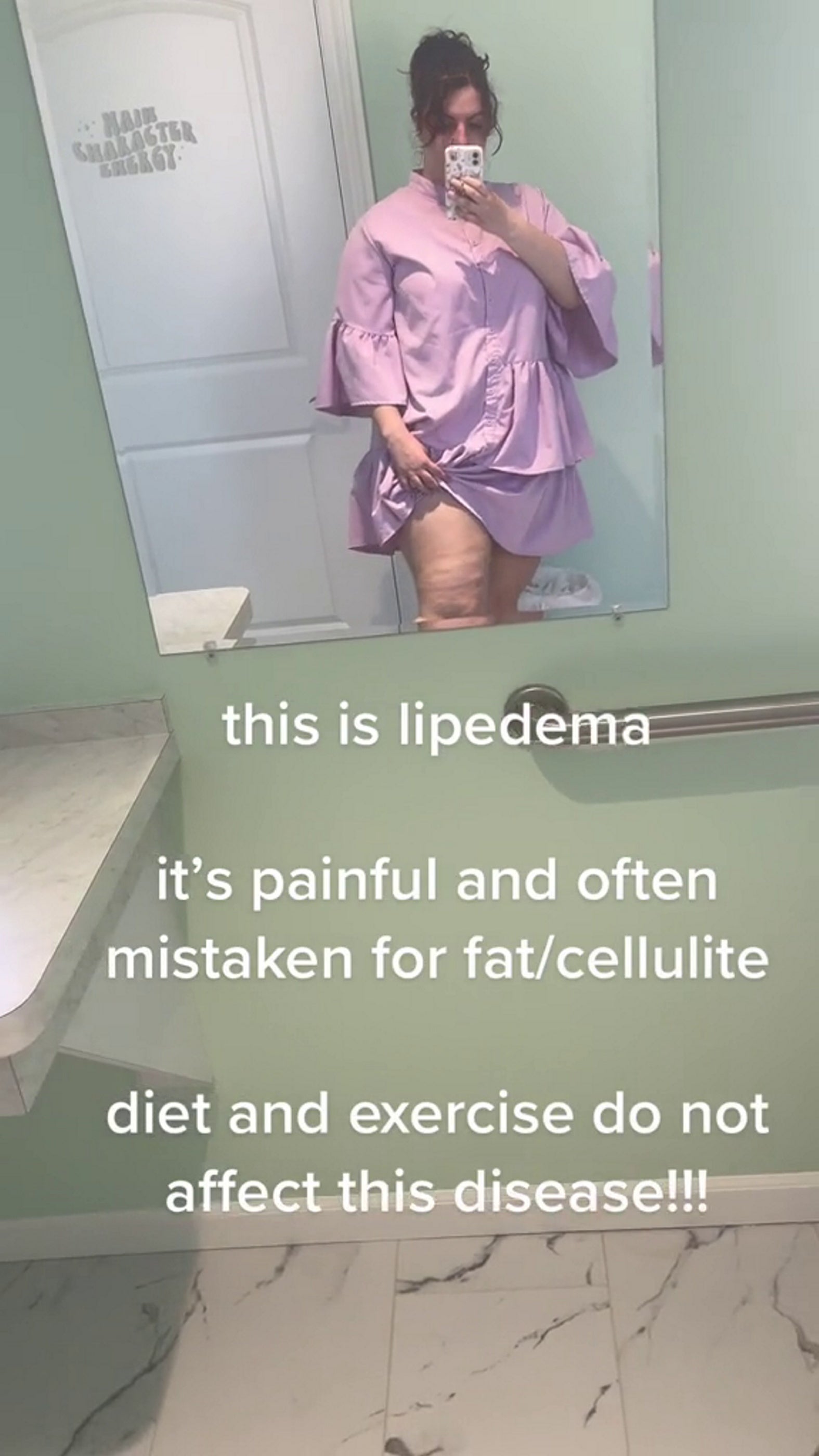 Doctors told Alisa she would need six surgeries to remove the lipoedema nodules - of which she’s so far had one