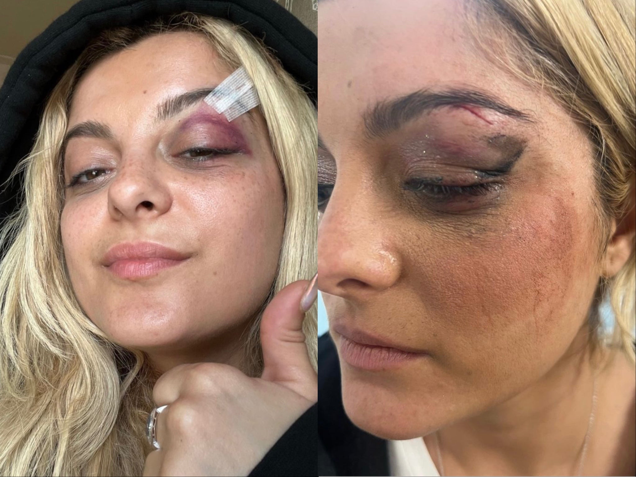 Bebe Rexha received stitches above her left eye after a fan threw their phone at her on stage in 2023