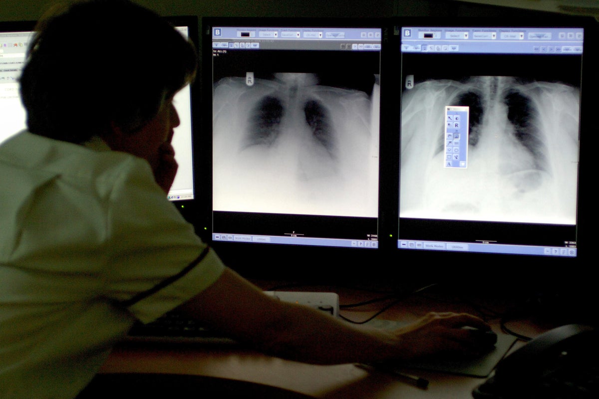New dual-action drug a ‘promising step forward' for patients with hard-to-treat lung cancer