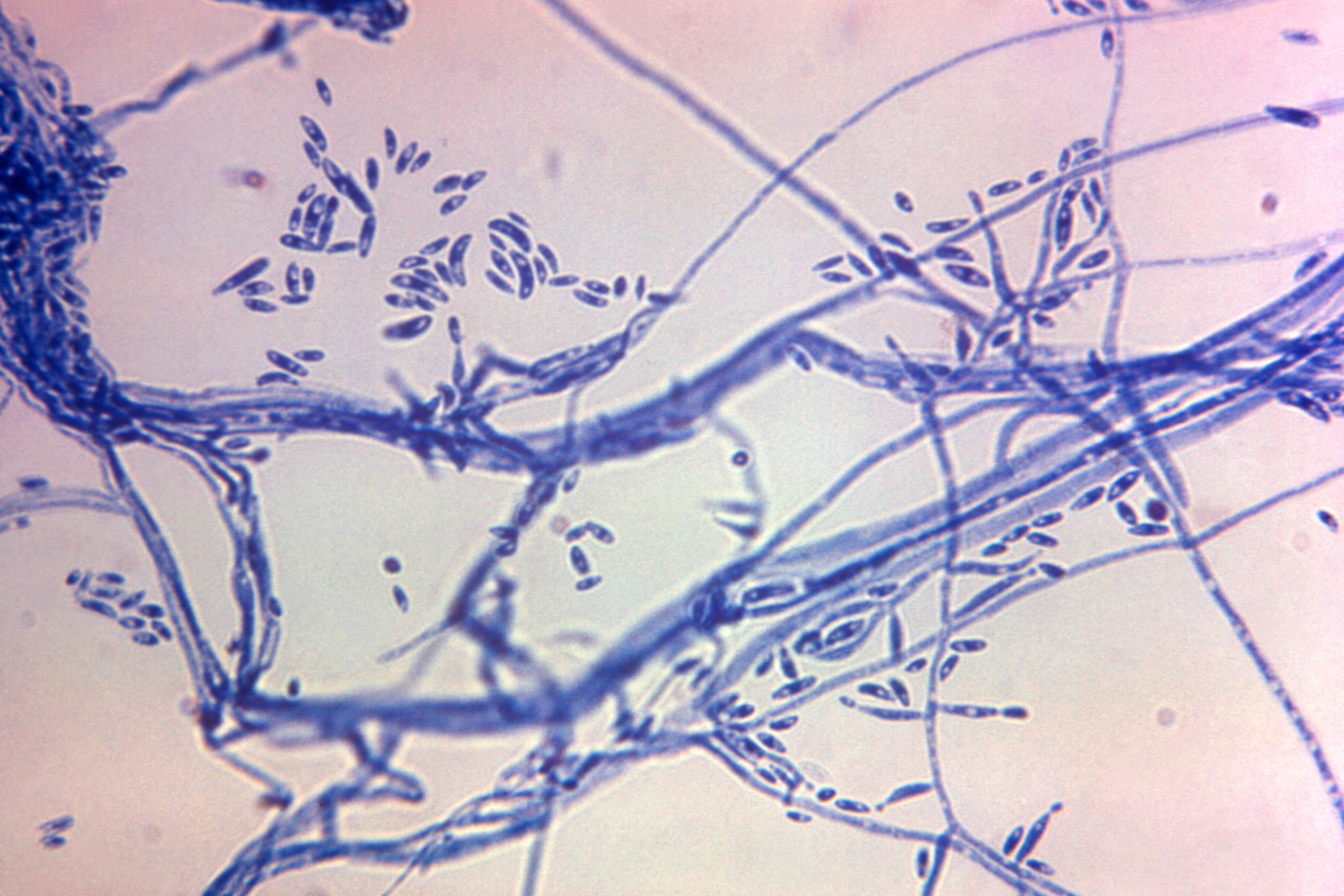 Fungal Meningitis Outbreak Mexico