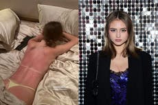 Heidi Klum’s model daughter Leni shows off grisly burn after admitting she ‘didn’t use enough sunscreen’