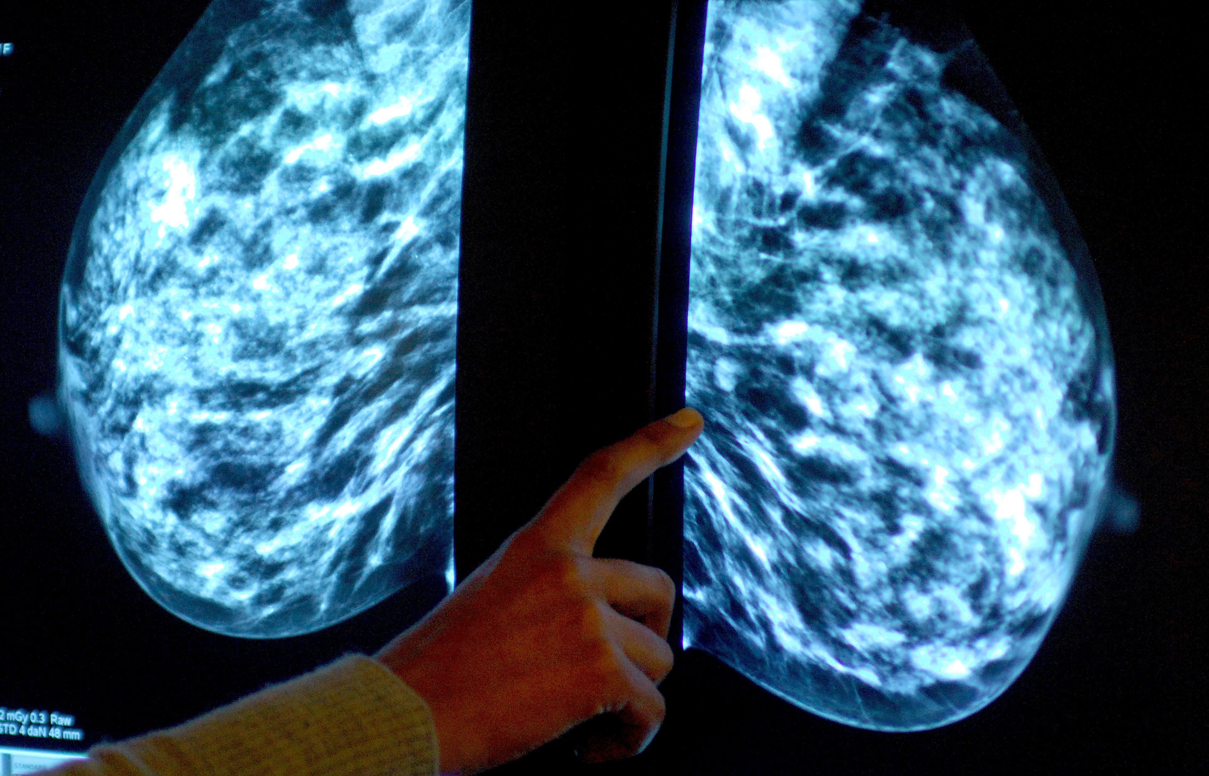 A mammogram shows a woman’s breast being checked for breast cancer at Derby City Hospital