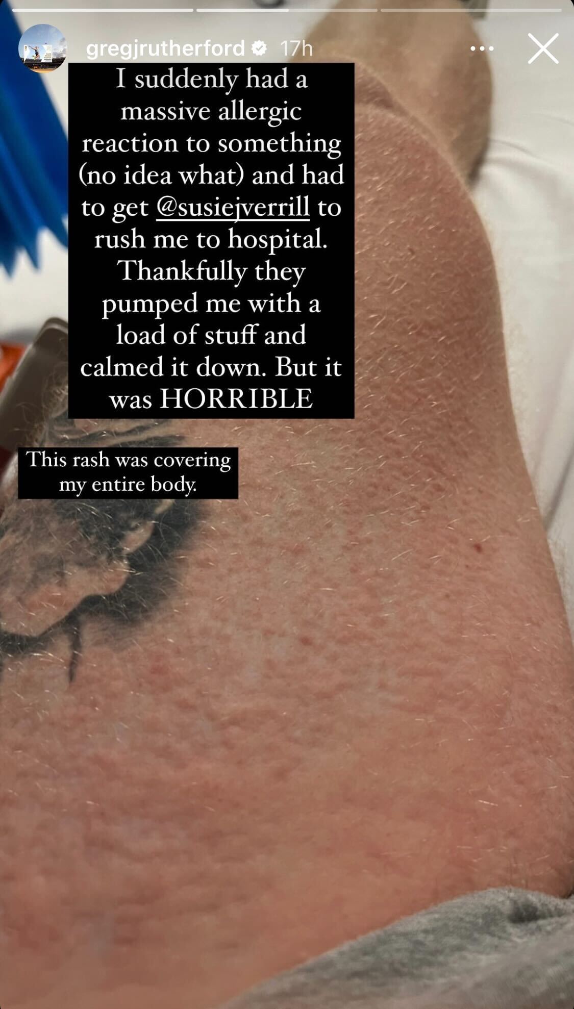 Greg Rutherford shares a close-up of the skin rash he experienced