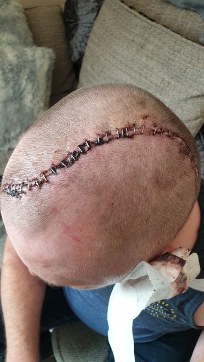 He has recently had surgery to put a titanium plate in his head to replace where his skull should have been