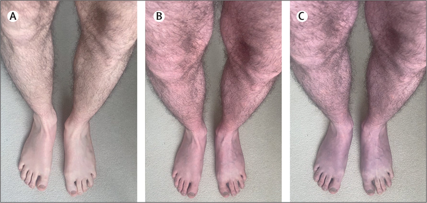 The 33-year-old patient experienced “rapid purple discolouration” on his legs