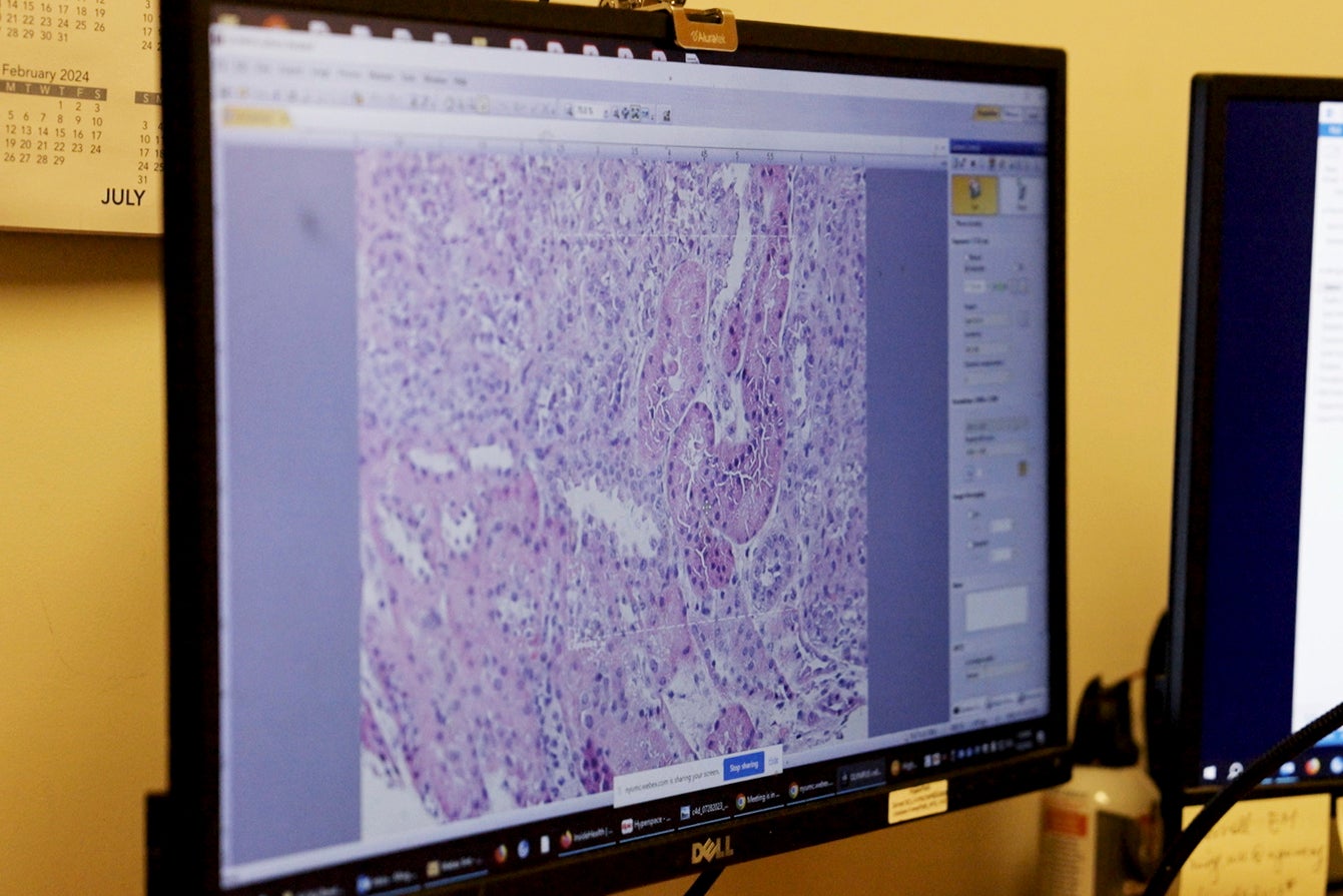 Pig Human Transplants