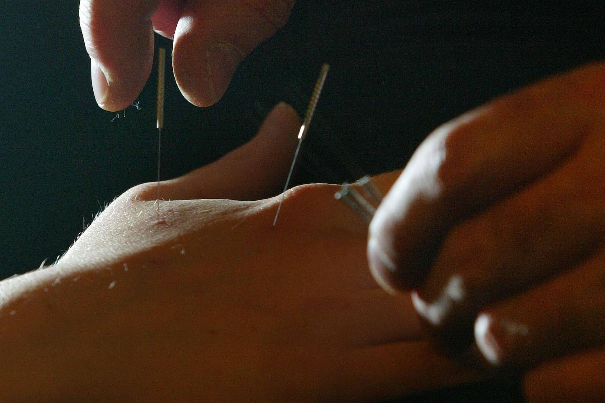 Acupuncture is a system of treatment using the insertion of needles into specific points on the body (David Cheskin/PA)