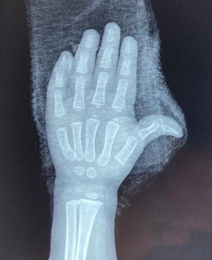 An x-ray of the toddler’s hand