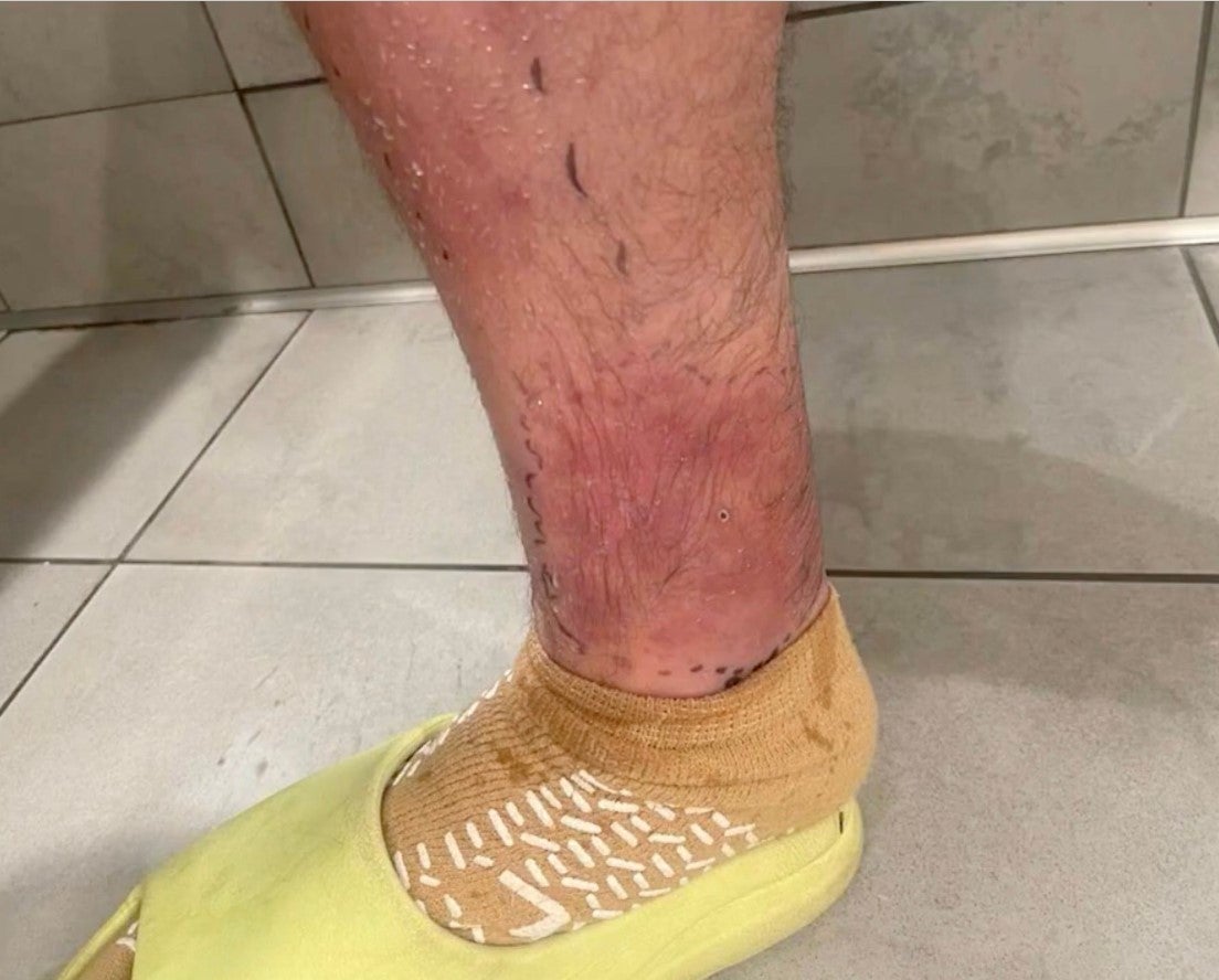 Lustman said he initially ignored the warning signs of his spider bite.