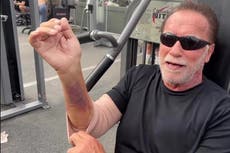 Arnold Schwarzenegger, 76, works out with badly bruised arm while recovering from surgery