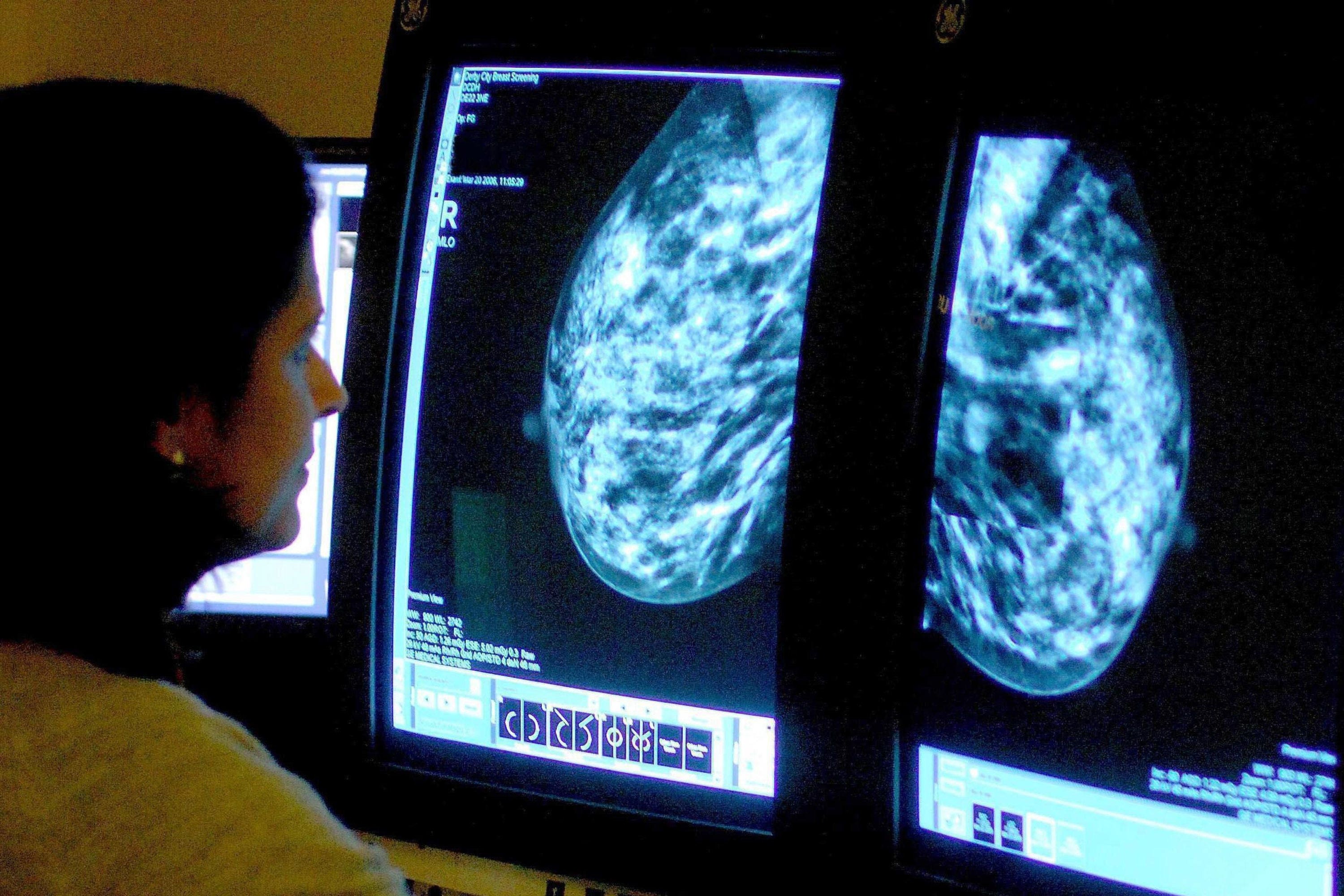 A new treatment for HER2-low breast cancer has not been approved for NHS use in England (PA)