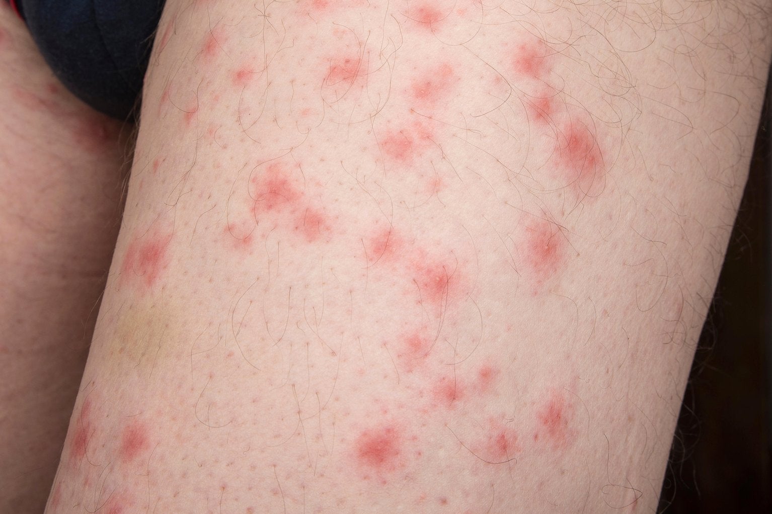 Typical bedbugs bite