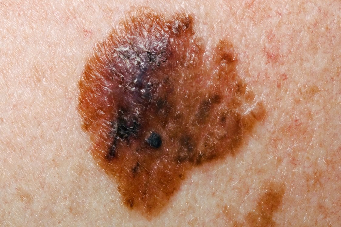 An example of what melanoma could look like
