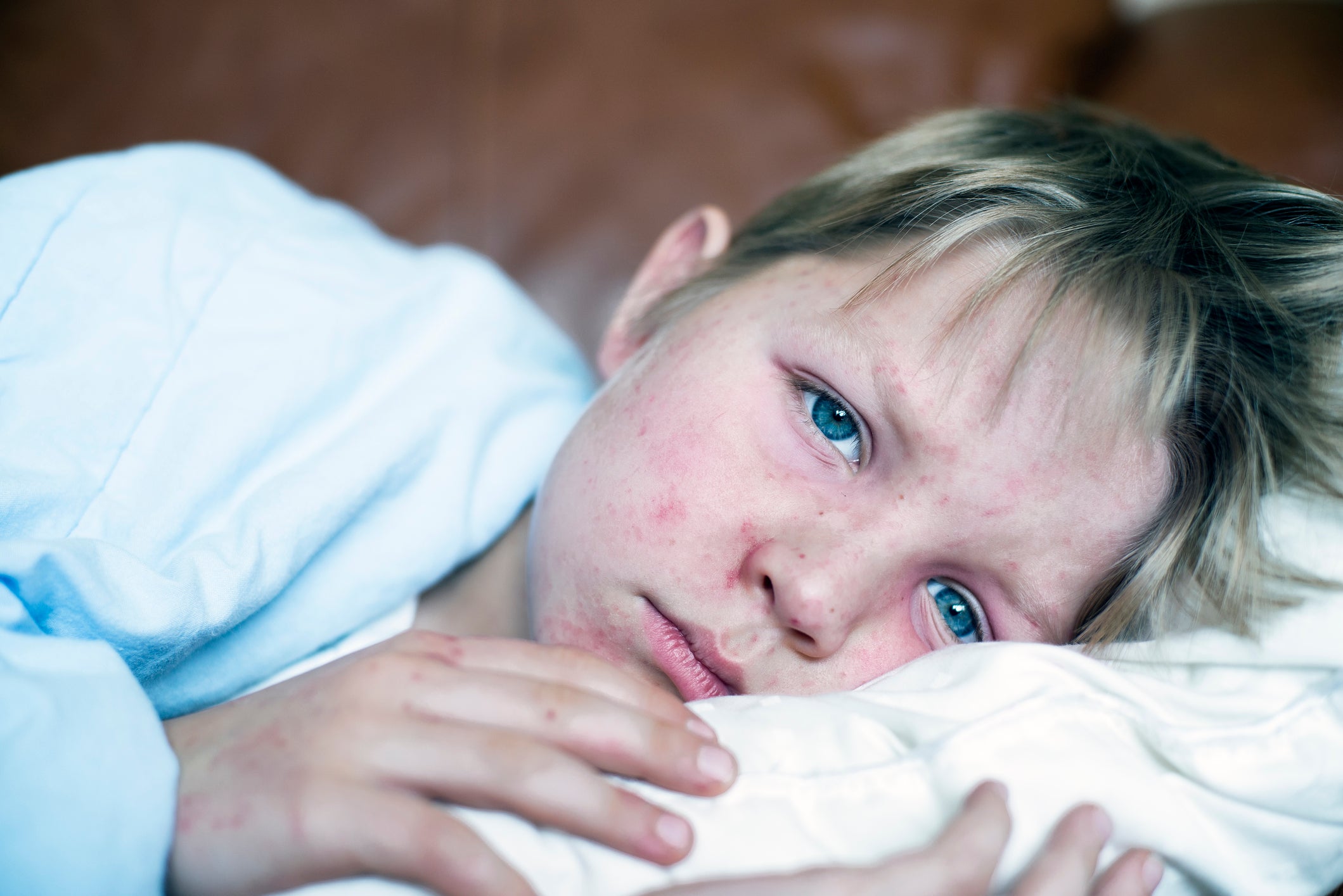 Two in five cases were in children aged one to four with parents urged to get their children vaccinated