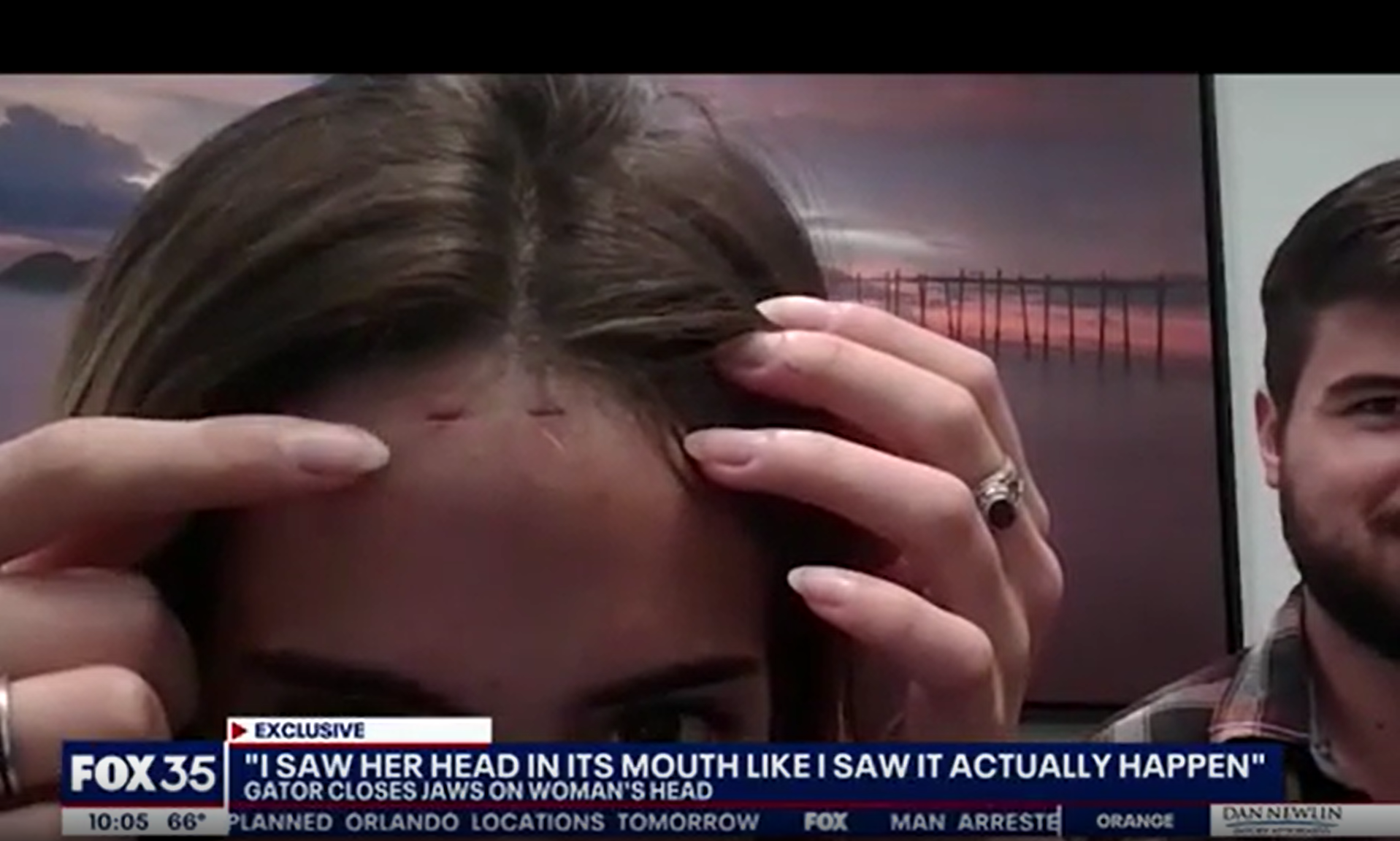 She sustained bite marks on her head as well as on her neck