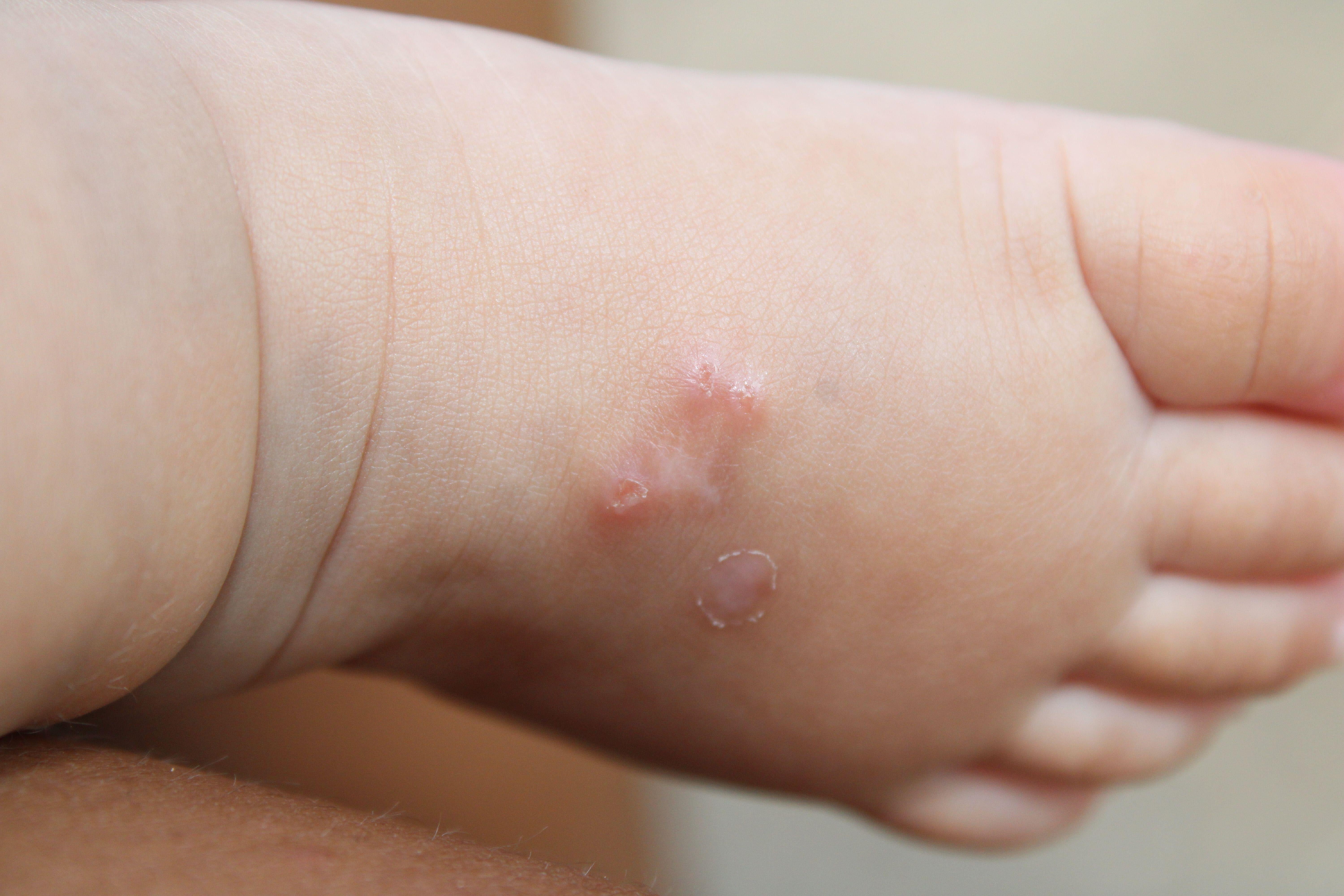 Scabies cases are above the five-year average in England, GPs warned