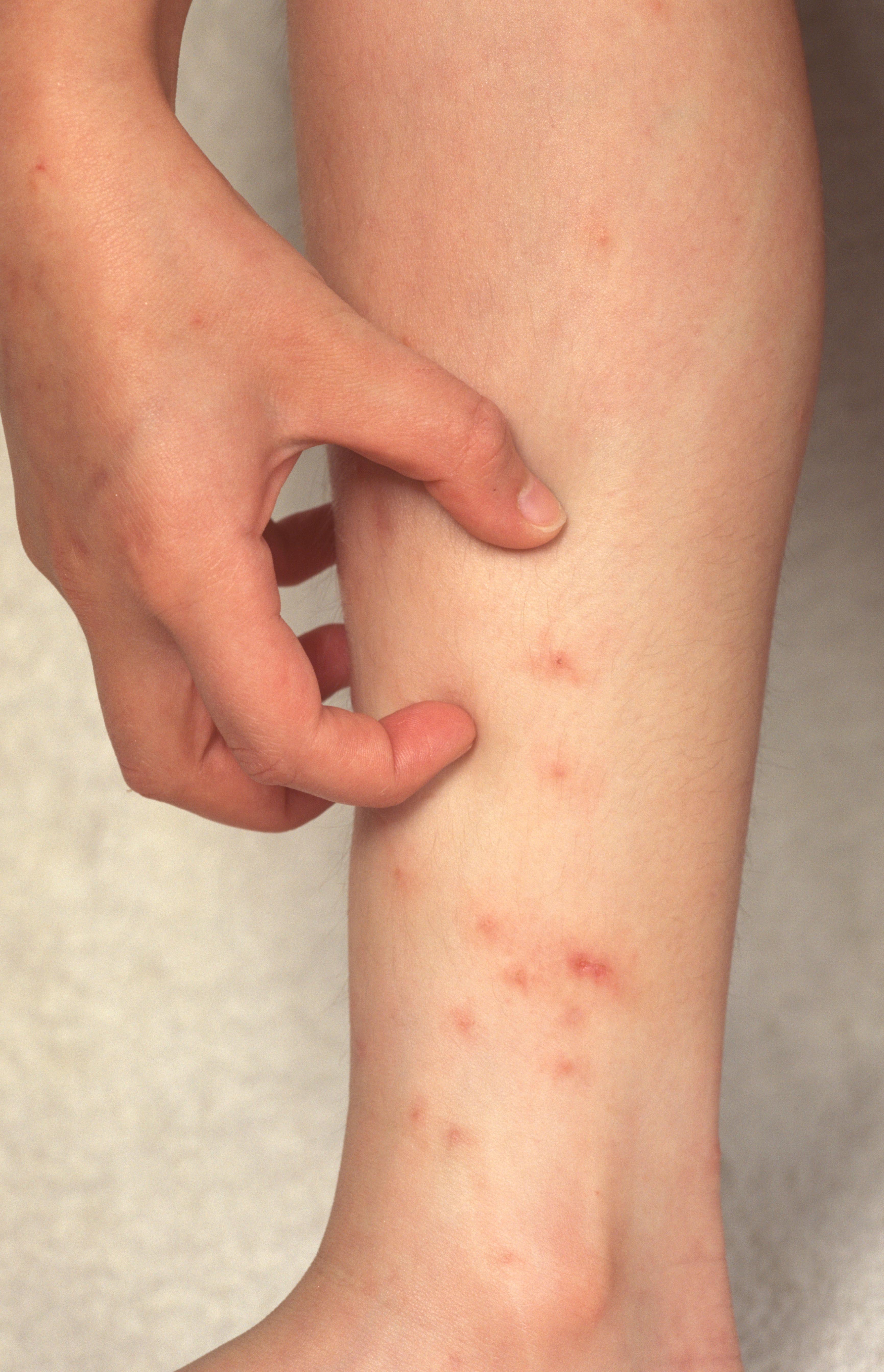 A scabies rash