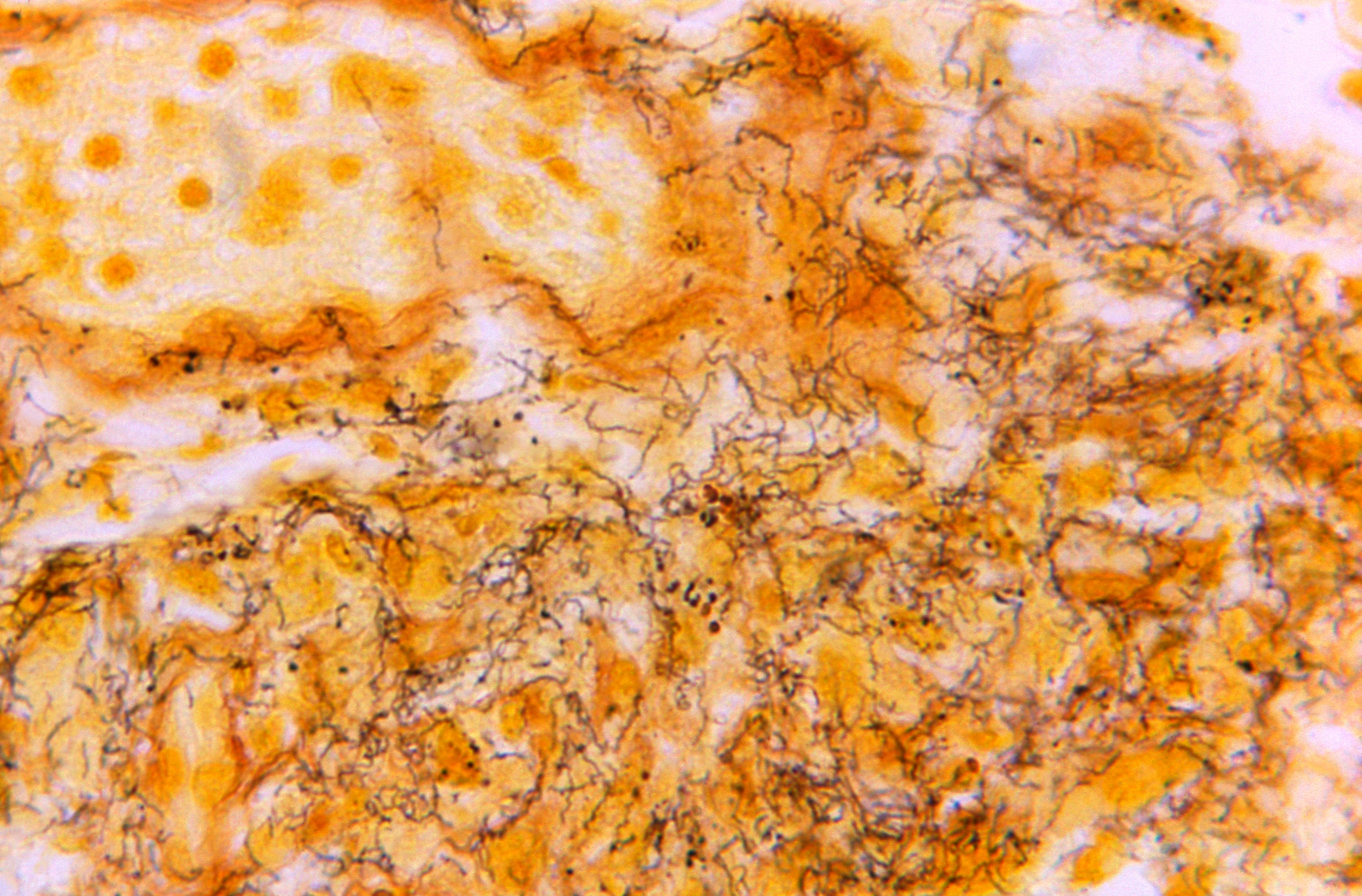 This 1966 microscope photo made available by the Centers for Disease Control and Prevention shows a tissue sample with the presence of numerous, corkscrew-shaped, darkly-stained, Treponema pallidum spirochetes, the bacterium responsible for causing syphilis