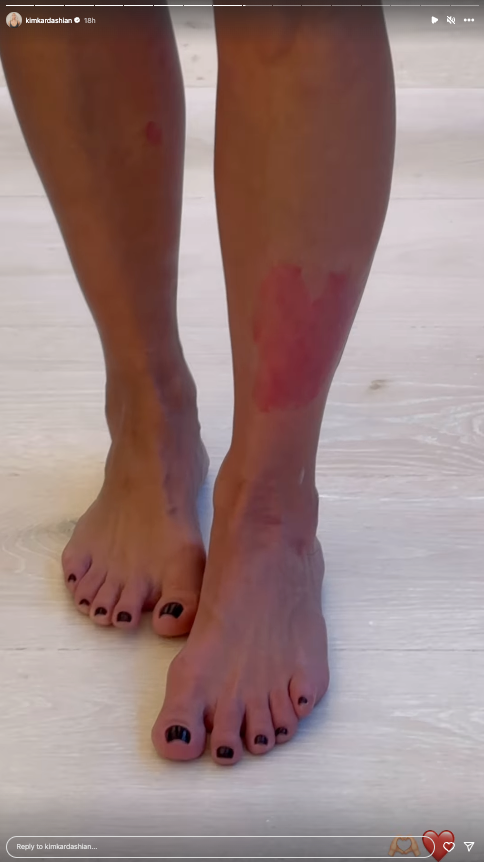 Kim Kardashian jokes psoriasis flareup resembles the shape of a heart