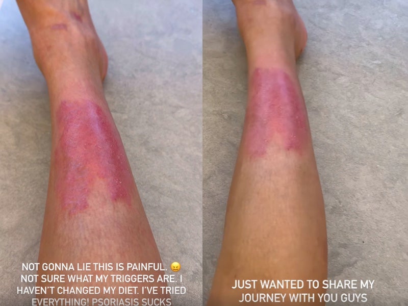 Kim Kardashian shares her psoriasis flareup