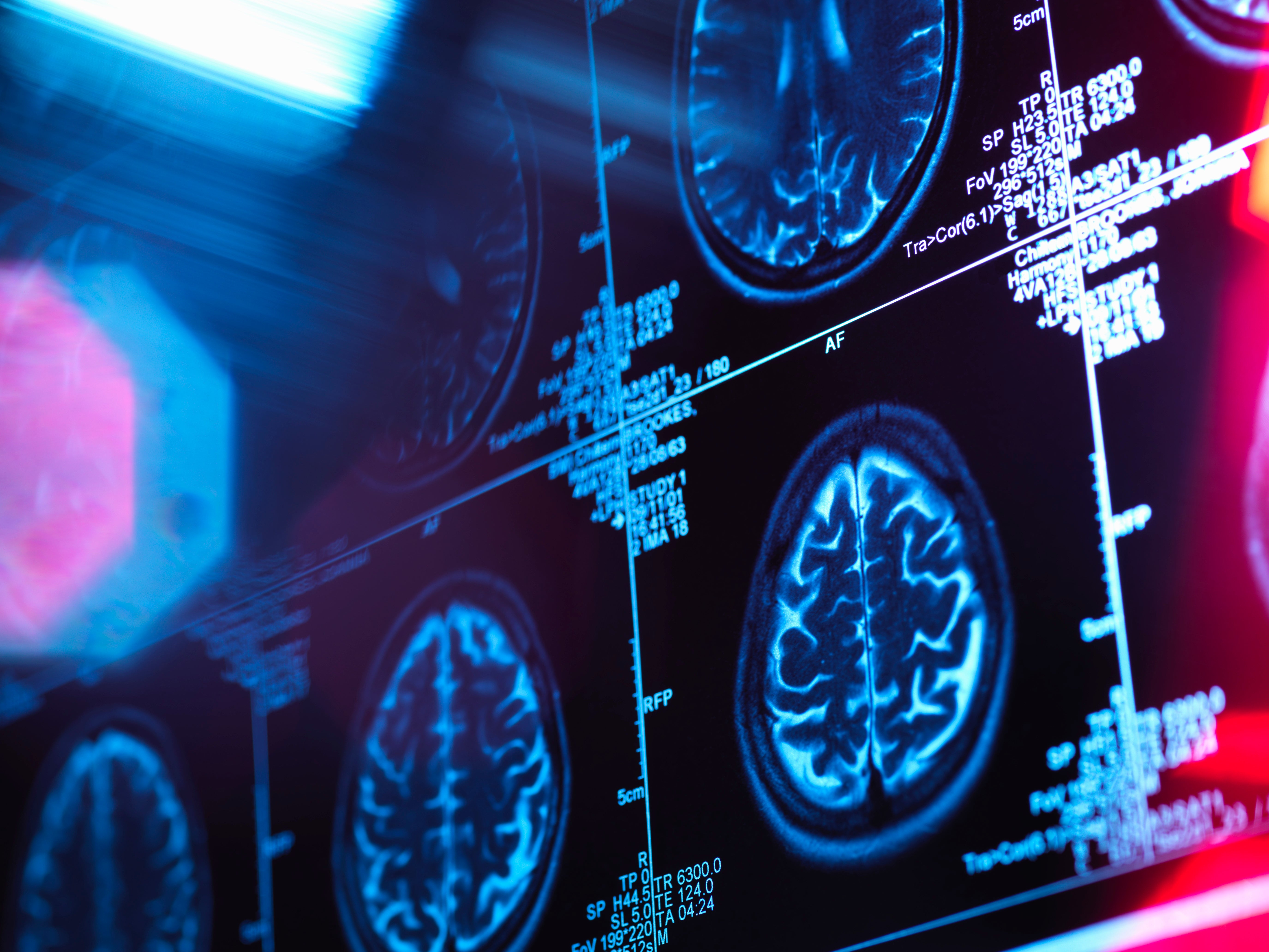 Dementia is the leading cause of death in the UK, with improved diagnoses in recent years leading to increased reporting