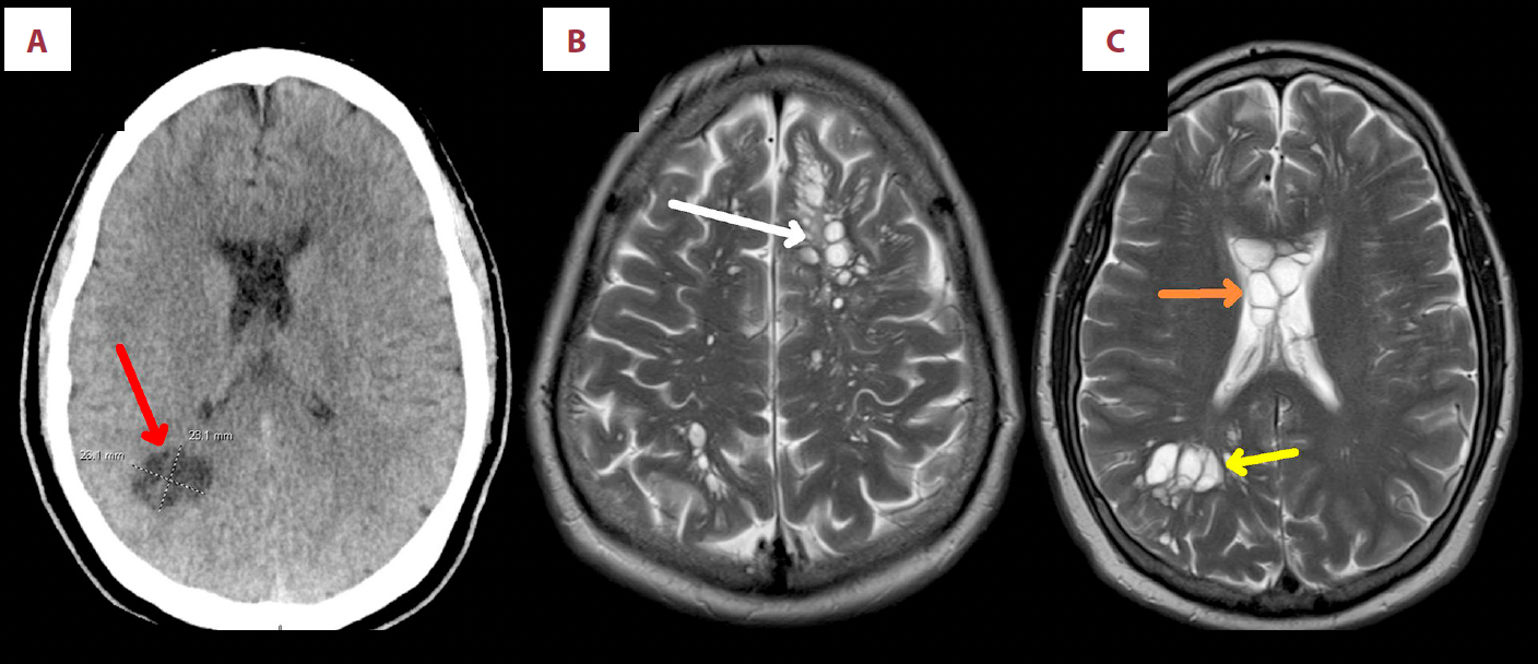 Brain scan showing man had many tapeworm larvae growing in different parts of his brain