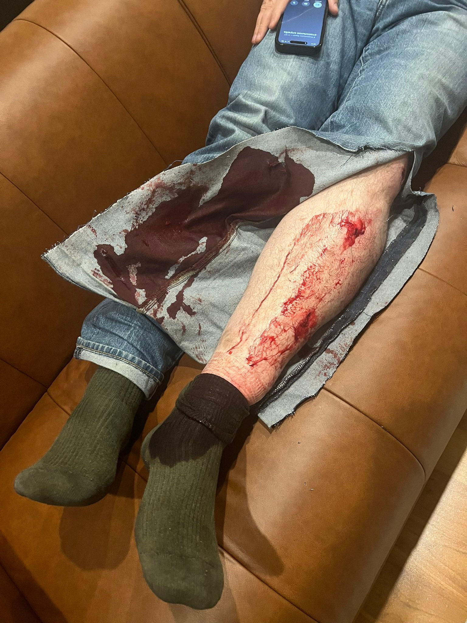 Leonid Volkov's wounds after he was attacked outside his home in Vilnius